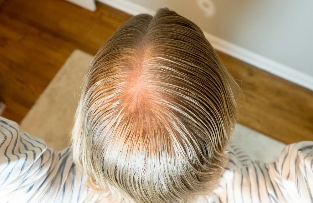 Thinning Hair Treatment